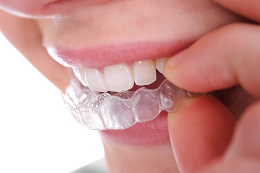 Centros Medicos Mapfre Salud_invisalign.jpg